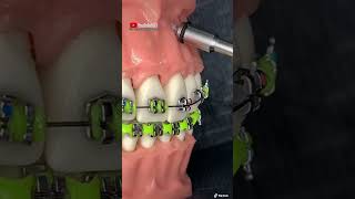 ¡Instalación de microimplante dental en los BRACKETSBRACESFRENILLOS ORTODONCIA [upl. by Yna]