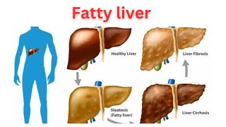 fatty liver Non Alcoholic FattyLiverDisease Liver Awareness Health Education [upl. by Debbra]