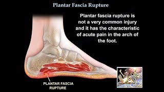 Rupture of the Plantar Fascia  Everything You Need To Know  Dr Nabil Ebraheim [upl. by Nonnaehr494]