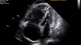 Pulmonary Hypertension echo [upl. by Cherry886]