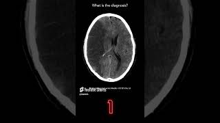 Brain CT Question 4 [upl. by Aihsenod]