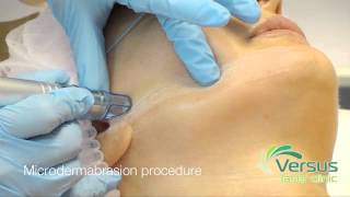 Microdermabrasion step by step demonstration [upl. by Sheppard865]