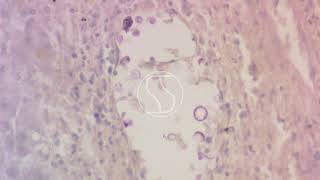 Cryptococcus neoformans under the microscope with Periodic acidSchiff PAS stain [upl. by Nemajneb180]