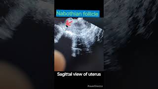 Nabothian follicle in cervix cervix cervicitisultrasound sonography doctor [upl. by Drhcir386]