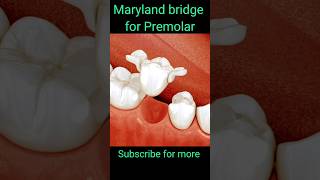 maryland bridge  premolar maryland bridge  dental asmr  shorts viral dental asmr [upl. by Dall53]