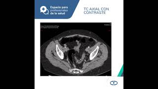 Espacio para Profesionales de la Salud  Colonoscopia Virtual [upl. by Irita]