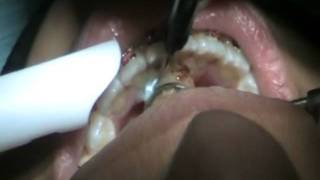 ORAL TUMOR EXCISION BY DIODE LASER WITHOUT ANESTHESIA DR MANAF TAHER AGHA [upl. by Adalie]