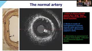 Optimizing PCI Using FFR and HD IVUS Part 2  The Benefits of IVUS in Acute Coronary Syndrome [upl. by Mcmaster]