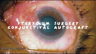 MIIQ 97 Pterygium Surgery Conjunctival Autograft with Sutures  DR MD IFTEKHER IQBAL RAJU [upl. by Gail137]