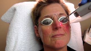 Nd YAG Laser Treatment for Rosacea at Total Body Care [upl. by Thamora149]