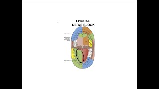 Lingual Nerve Block Injection [upl. by Hanej]