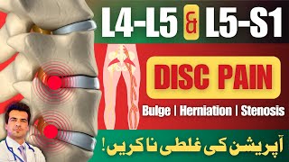 L4L5 amp L5S1 Disc Bulge Treatment  No Surgery  Home Treatment  UrduHindi [upl. by Annohsak]