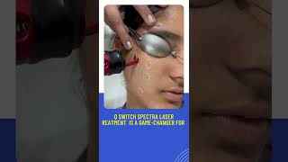 Q Switch Spectra LASER treatment in Indore  Dr Monika Choudhary  Skin Dr [upl. by Zined]