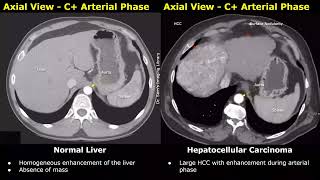 CT Scan Liver Normal Vs Hepatocellular Carcinoma HCC Images  Liver Cancer Imaging Diagnoses [upl. by Akselav135]