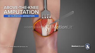 Surgical Animation Portrays AbovetheKnee Amputation [upl. by Neufer]