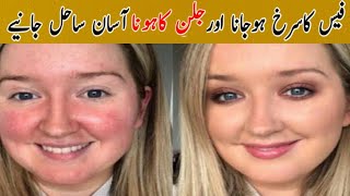 Fece Redness treatment at homechehre ki Redness khatam karne ke 2Asan tarike [upl. by Ennovyahs852]