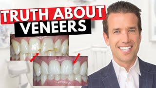 Before you get Dental Veneers Watch This  Are Veneers Worth It [upl. by Linsk912]