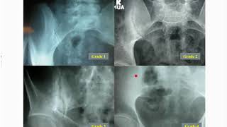 The Diagnosis and Management of Axial Spondyloarthritis [upl. by Kenweigh]