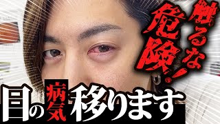 【結膜炎】感染力、超強力！ただの充血じゃない！あなたもうつる可能性大です！！ [upl. by Yeffej]