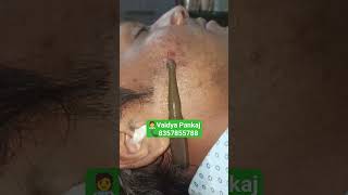 Leech therapy for skin disease ayurvedaviralshortvideo trending eczema yt india punjabisong [upl. by Lanevuj]