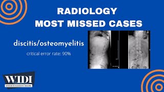 Most Missed Cases DiscitisOsteomyelitis [upl. by Caty885]