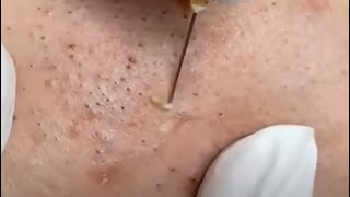 Hidden Giant Blackheads Removal On Face [upl. by Enalahs517]