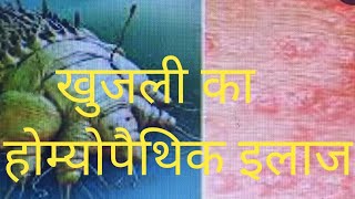 Scabies  खुजली का होम्योपैथिक इलाज [upl. by Arde474]