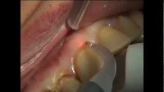 PHILIPS LASERS Gingivectomie multiple 1 [upl. by Arahahs]