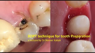 BOPT Technique in tooth preparation [upl. by Horatio648]