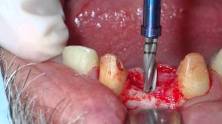 Dental implant placement in central incisor maxilla [upl. by Haida]