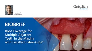 Root Coverage for Multiple Adjacent Teeth in the Maxilla with Geistlich FibroGide® [upl. by Birgitta139]