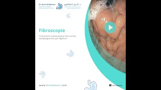 Fibroscopie  Traitement endoscopique des varices œsophagiennes par ligature [upl. by Selokcin197]