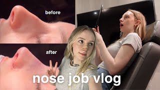 nose job vlog  rhinoplasty recovery amp results [upl. by Ainesy]