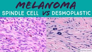 Spindle Cell vs Desmoplastic Melanoma Made Simple [upl. by Notnyw]