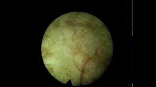 Cystitis cystica focal inflammation of the bladder Intertitial cystitis [upl. by Bahner]