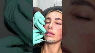 Lip Filler Technique using Hyaluronic Acid Filler fillersinjection lipsfiller filler [upl. by Komsa]