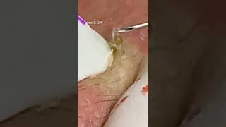 Pickel Ausdrücken Blackheads Mitesser Entfernung 🔴 62 [upl. by Ithnan]