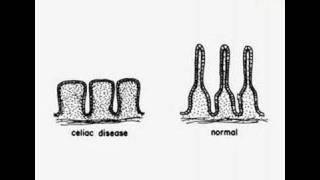 Histopathology Small intestineCeliac sprue [upl. by Ttirrem]