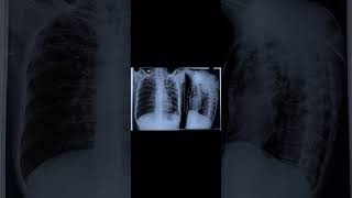 Miliary Koch’s  Chest X Ray  DopaMine tuberculosis miliarykochs chestxray radiology medicine [upl. by Yehc]