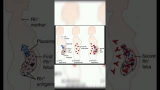 How erythroblastosis fetalis avoided Treatment for erythroblastosis fetalis [upl. by Aohsoj]