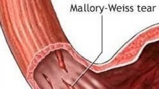 A tell of 2 Brothers Tear of Esophagusছিঁড়ে যাওয়া গ্রাসনালীর গপ্পো Boerhaave Vs Mallory Weiss [upl. by Ahsiened871]