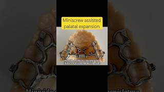 Miniscrew assisted palatal expansion dentist miniscrew manavgatdentist side [upl. by Attirehs]