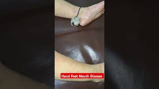 Hand Foot Mouth Disease bgm motivation cutebabyringtone bgmringtone baby new2021 funny [upl. by Rehctaht388]