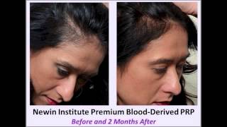 Hair Loss PRPStem Cell Therapy2 month comparison Largem4v [upl. by Map173]