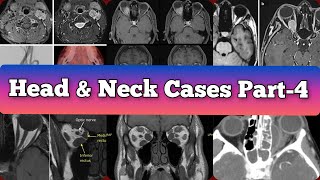 Radiology Viva Cases  393398  Head and Neck Exam Cases Part 4 medical radiology [upl. by Lleruj890]