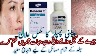 Best Acne Lotion  Dalacin T Lotion  Calindamycin 1 Acne Lotion Review In Urdu Hindi [upl. by Concoff]