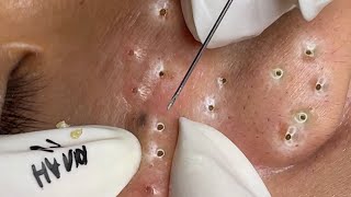 Big Cystic Acne Blackheads Extraction Blackheads amp Milia Whiteheads Removal Pimple Popping  3868 [upl. by Godfry526]