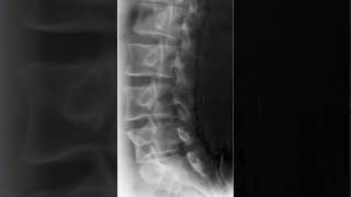 Lumbar Spine Oblique Radiology Tutorial [upl. by Yerxa980]