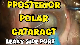 posterior polar cataract with inadvertently enlarged side port managed nicely [upl. by Kirby]