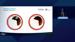 TCT 2022 Controversies in Calcium An OpenMinded Debate on Approaches to Nodular Calcium [upl. by Ellinehc]